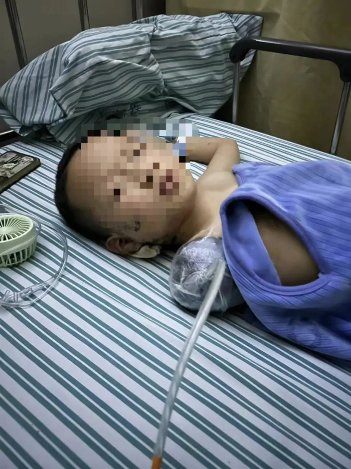 在医院治疗的硕硕，图片来源：澎湃新闻