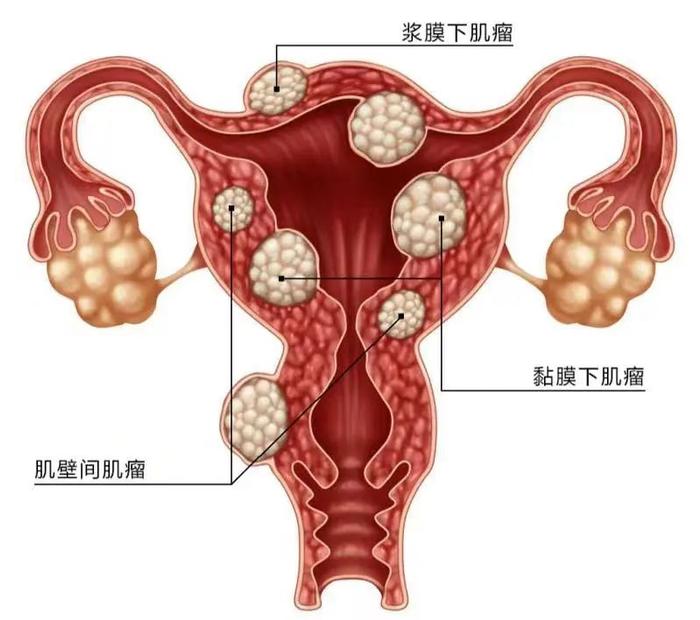 子宫浆膜层示意图图片