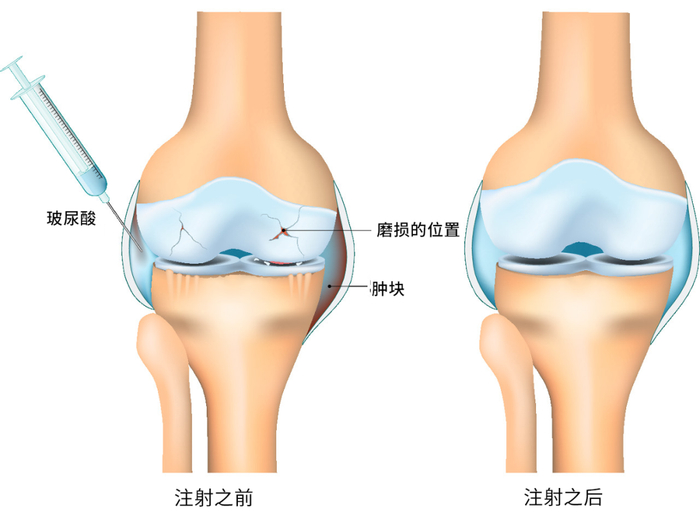 玻尿酸也被用于关节腔注射治疗关节炎。图库版权图片，不授权转载
