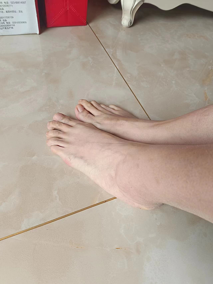 笑笑的脚，较常人的脚大出许多，有43码。&nbsp;&nbsp;本文图片均为 受访者 供图