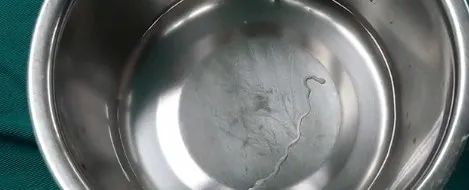 从患者颅内抓取的11cm长活虫