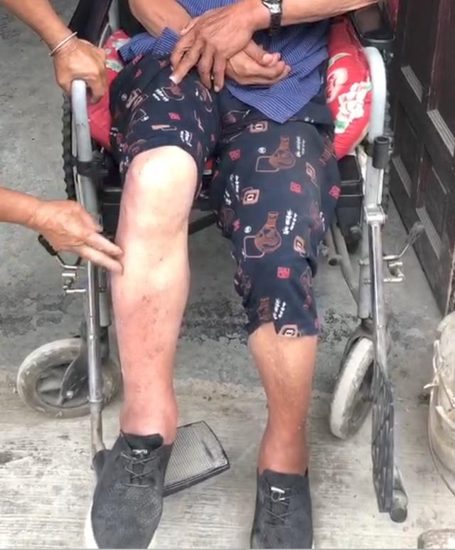 2021年5月，阳曙文以自己名义网购处方药，其父服用后出现双腿浮肿的副作用。受访者 供图