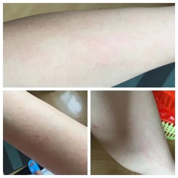 *有些脱毛产品真的是坑人