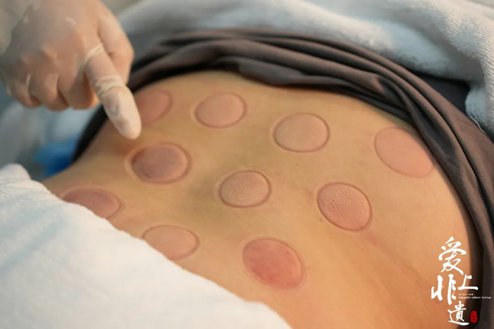 通过观察罐印颜色决定疗程。胡兆双 摄