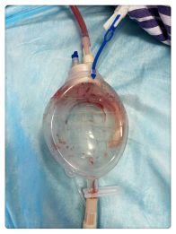 为什么负压引流为什么术后要放置腹腔引流管,放置原则及相关注意事项_新闻资讯_第4张_活检穿刺产品网 为什么负压引流为什么术后要放置腹腔引流管,放置原则及相关注意事项_https://www.jmylbn.com_新闻资讯_第4张