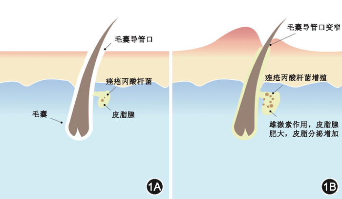 几乎所有人都长痘!如何快速修复皮肤?最新医学指南:4大战痘秘诀,痘印、痘坑也有用