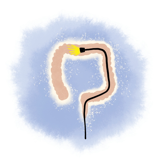     预防肠癌应从40岁开始就进行癌症筛查，筛查的“金指标”就是肠镜。视觉中国供图