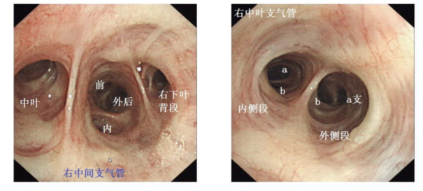 图 支气管镜方向