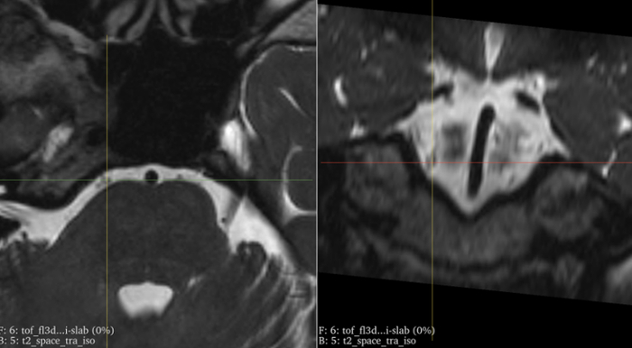 患者的外展神经薄层磁共振检查提示：右侧外展神经受压。上海新华医院 供图