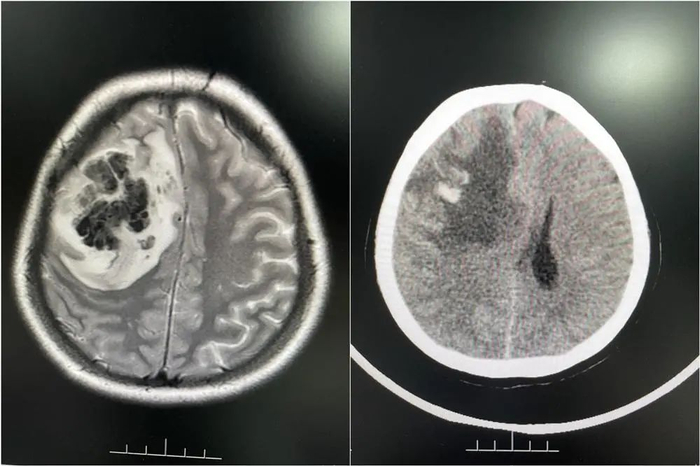 ▲ 影像检查提示右侧额叶占位性病变合并出血