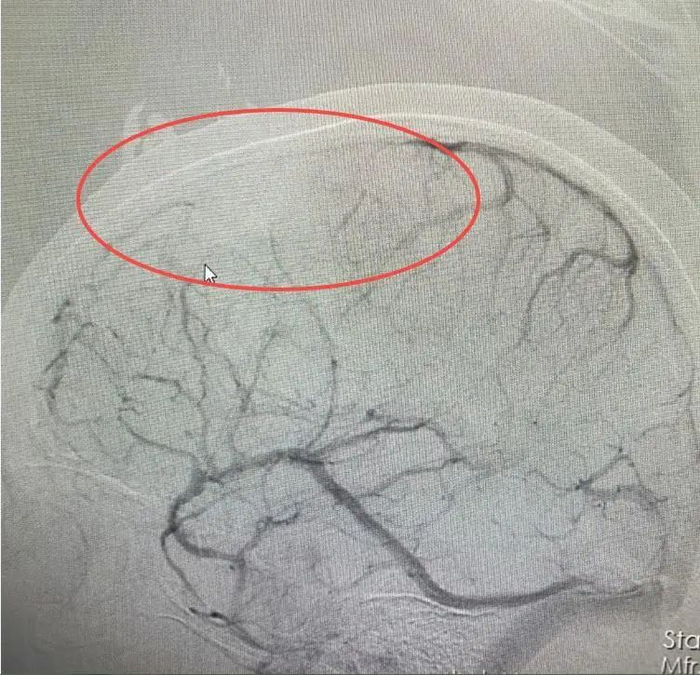 ▲ 全脑血管造影检查。