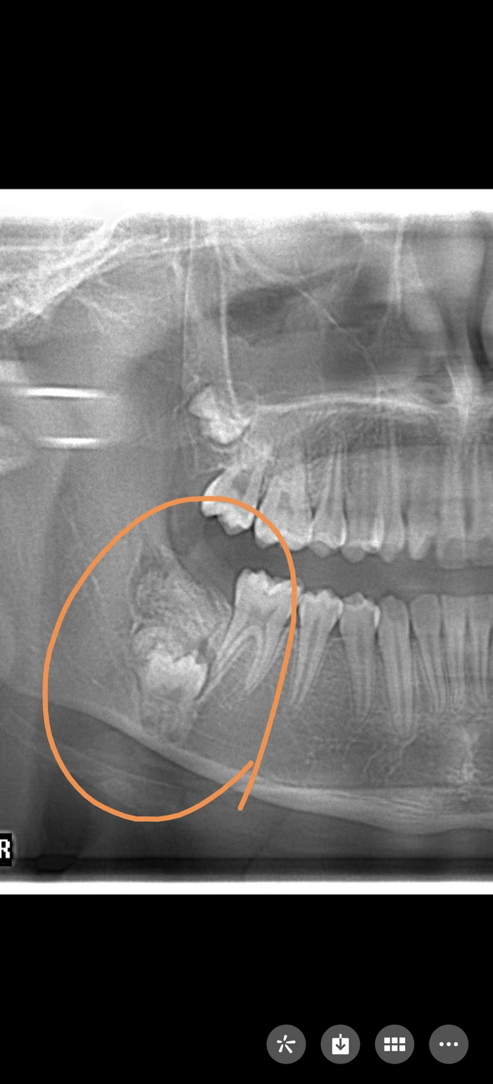 小雅的影像学报告。本文图均为上海市儿童医院 供图