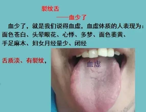 裂纹舌的调理|舌头|引水|舌裂|归脾汤|秋梨膏_新浪新闻