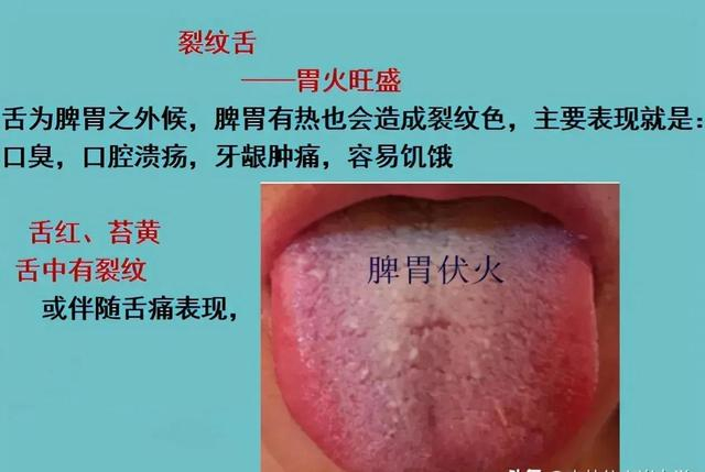 裂纹舌的调理|舌头|引水|舌裂|归脾汤|秋梨膏_新浪新闻