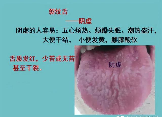 裂纹舌的调理|舌头|引水|舌裂|归脾汤|秋梨膏_新浪新闻