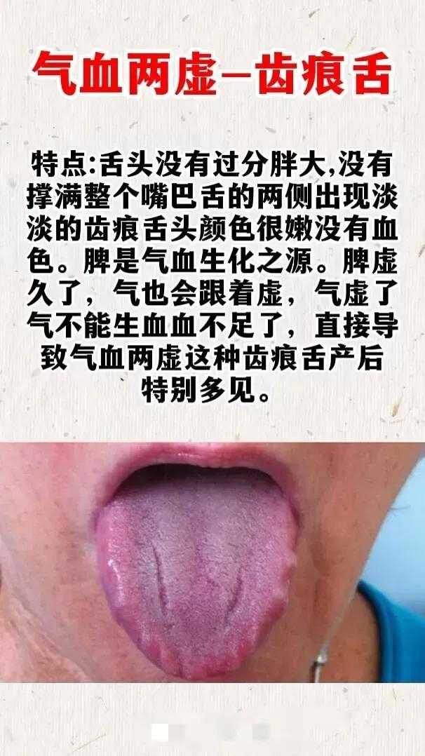 齿痕舌,调理方法就在这|附子_新浪新闻