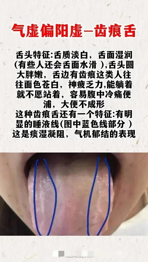 齿痕舌,调理方法就在这