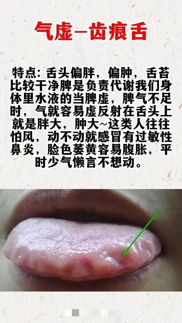 齿痕舌,调理方法就在这
