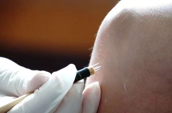 在贵州中医药大学第一附属医院产科病房，医生用针刺缓解产妇疼痛