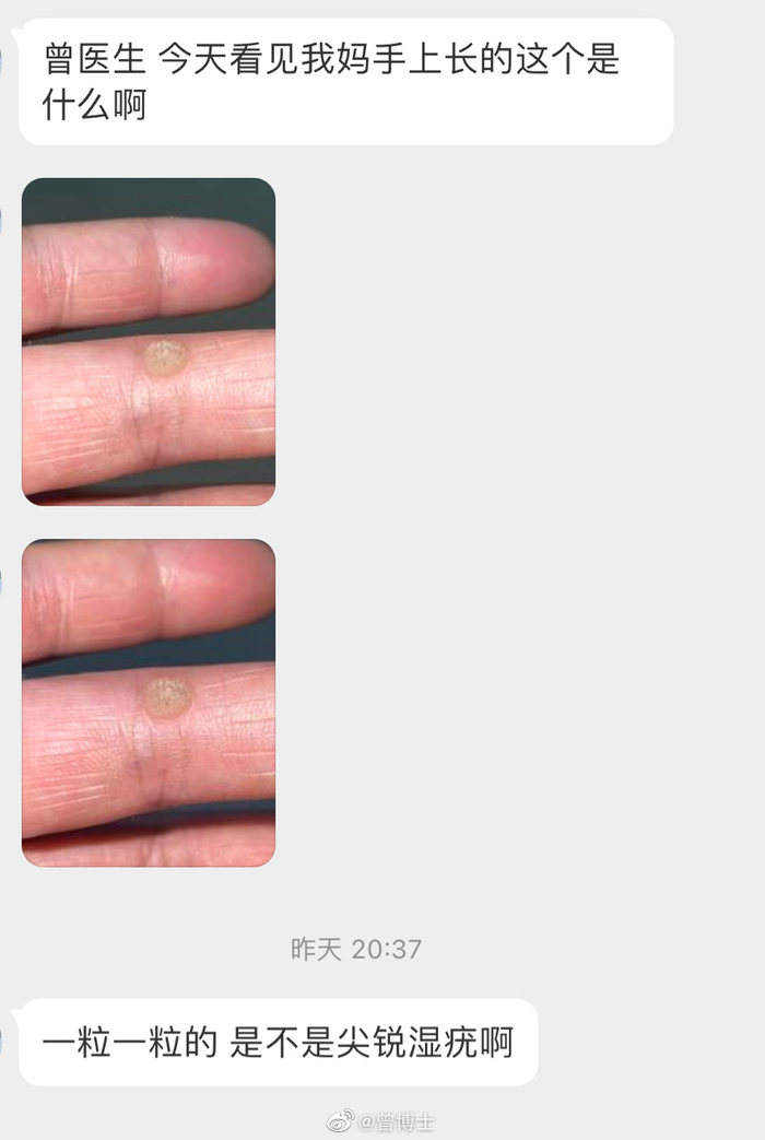 这应该是寻常疣,俗称“刺瘊”,不是尖锐湿疣……|激光|传染性|皮肤科_新浪新闻