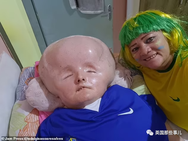 女子患脑积水30年头部肿大像外星人网友建议安乐死但却