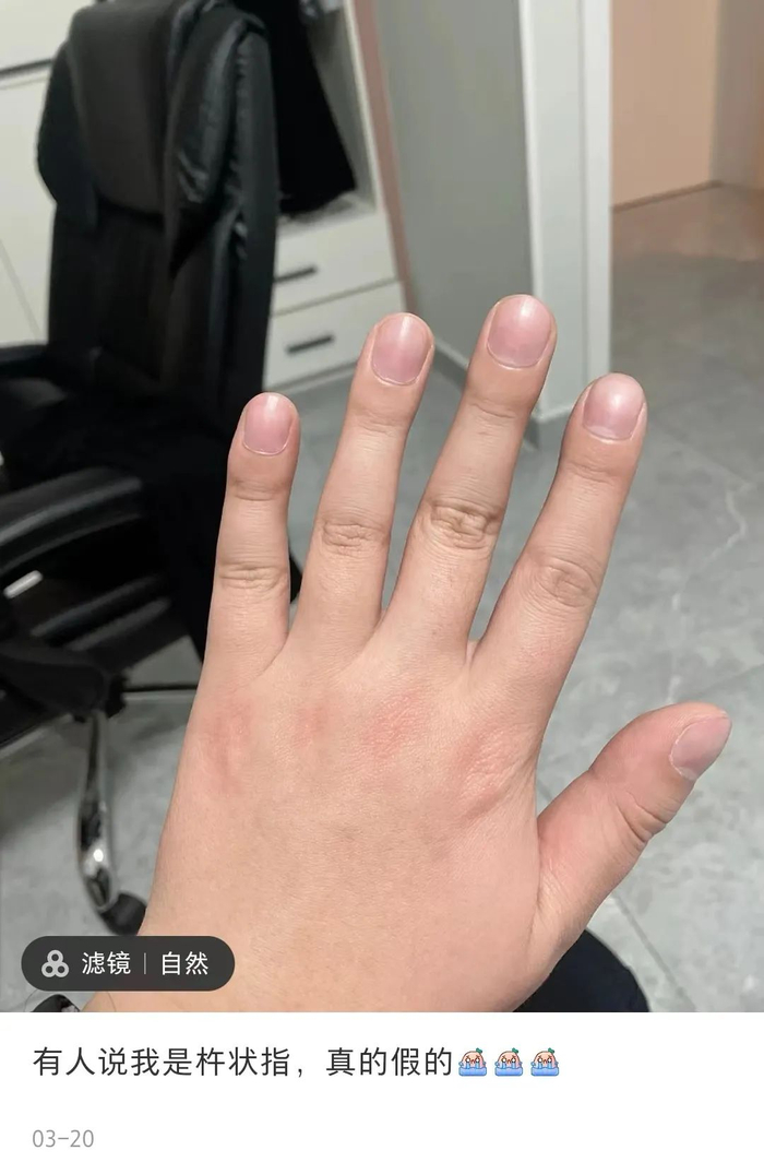 1个简单方法,赶紧自查!|手指|血管|疾病_新浪新闻