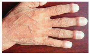 典型杵状指。来源：知网