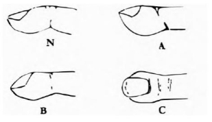 正常指与杵状指对比图。图源：知网