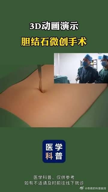 3d動畫演示膽結石微創手術_手機新浪網