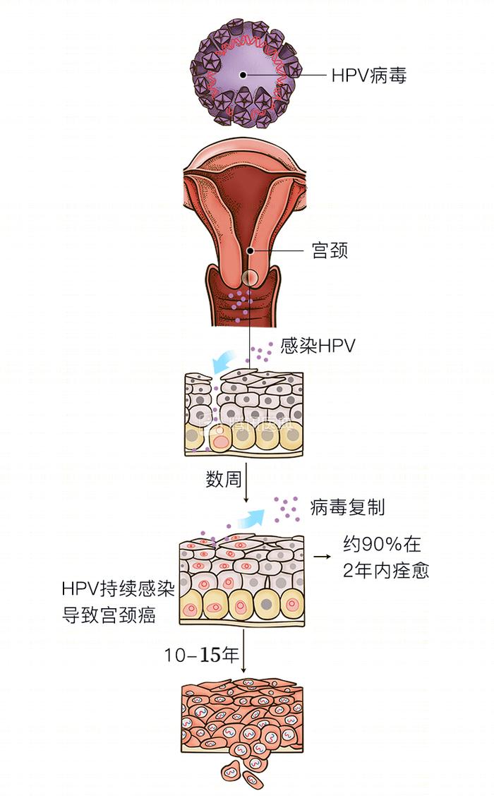 宫颈癌的宫颈图图片