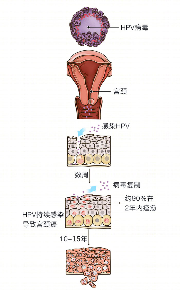 这个危险因素被很多人忽视|宫颈癌|hpv|感染_新浪新闻