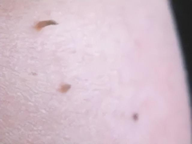 警惕!身上长的这些小疙瘩,可能跟HPV感染有关!