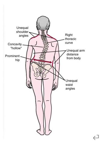 长短腿和脊柱侧弯。本文作者供图