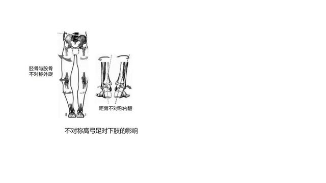 不对称高弓足对下肢的影响。本文作者供图