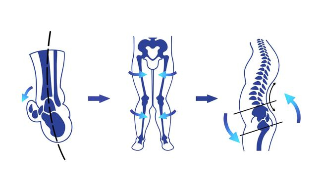 扁平足对人体的影响。本文作者供图