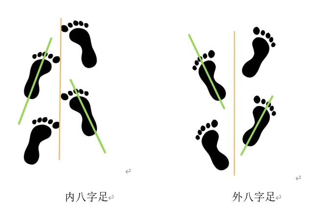 内、外八字足步态示意图。本文作者供图
