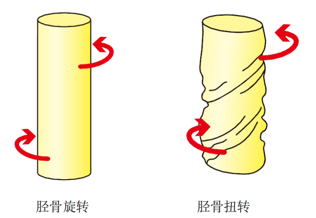 胫骨扭转的示意图。本文作者供图