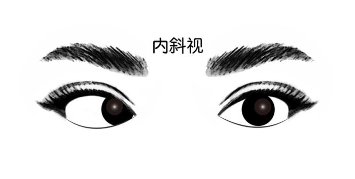 孩子总是斜眼看东西？真假斜视，和睦家眼科医生教您辨别