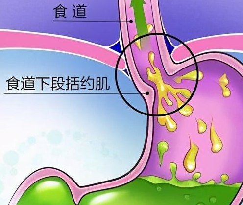 诊断胃食管反流，做这两个检查就可以了