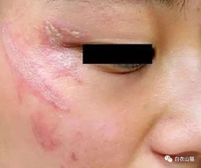 夏日里,能毁容的虫子岂只隐翅虫?记住这一点,并形成习惯,真的非常重要!|性皮炎|皮炎|马蜂|蜜蜂|蜇伤_新浪新闻