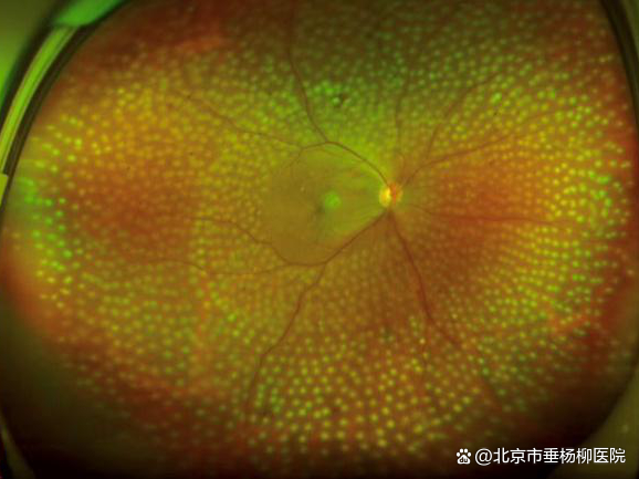 ▲眼底激光治疗