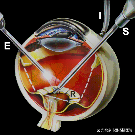 ▲玻璃体视网膜联合手术