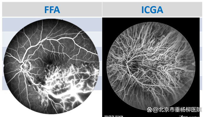 ▲眼底造影检查