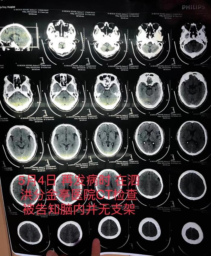 朱老汉在泗洪县分金亭医院的CT检查报告，显示颅内并无支架。朱先生供图