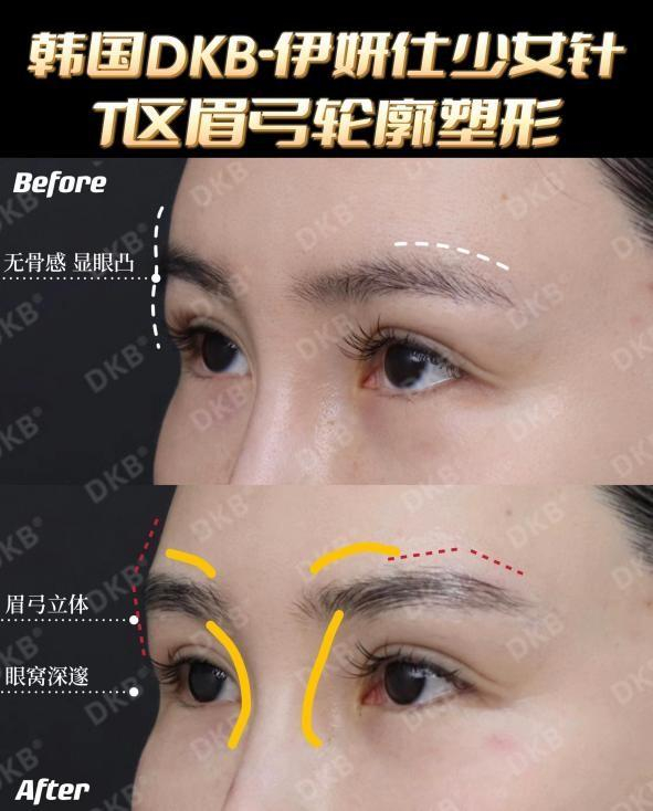臻至自然,定格高光,dkb伊妍仕少女针为用户打造完美双c线|隆鼻|眉心