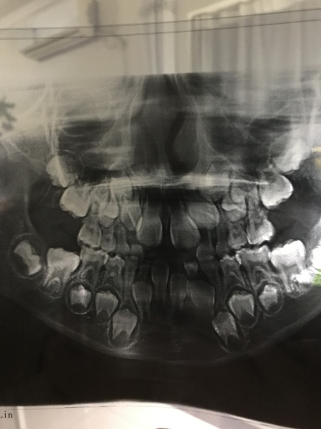 婴儿头部x光都是牙齿图片