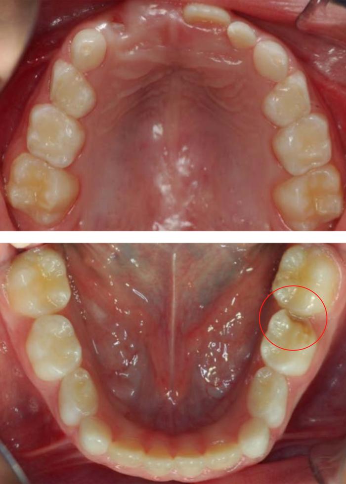上颌第一乳磨牙图片