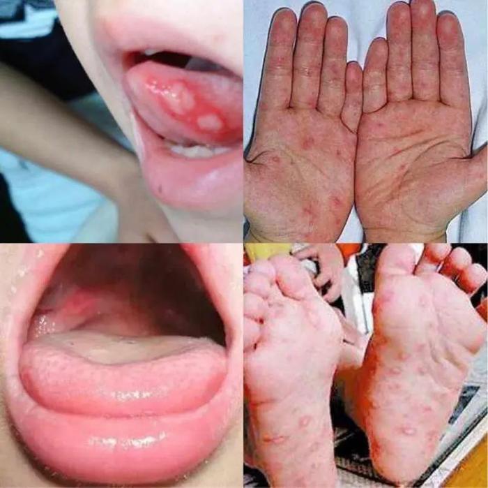 小孩手足口病喉咙图片图片