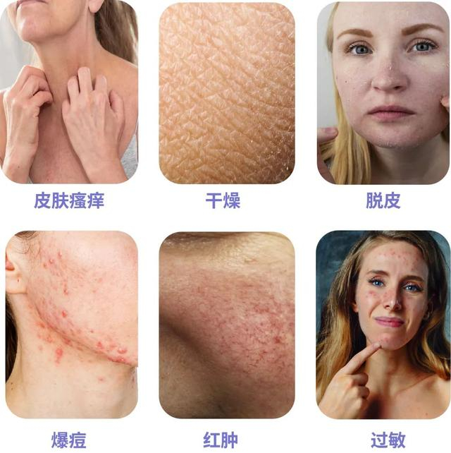 壳聚糖敷料什么时候用为什么越努力护肤,皮肤越差?罪魁祸首竟然是?_新闻资讯_第3张_活检穿刺产品网 壳聚糖敷料什么时候用为什么越努力护肤,皮肤越差?罪魁祸首竟然是?_https://www.jmylbn.com_新闻资讯_第3张