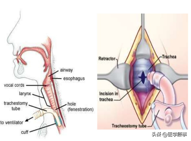 气管切开技术流程及注意事项|气管|套管|患者_新浪新闻
